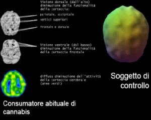 Cervello di un consumatore abituale di cannabis